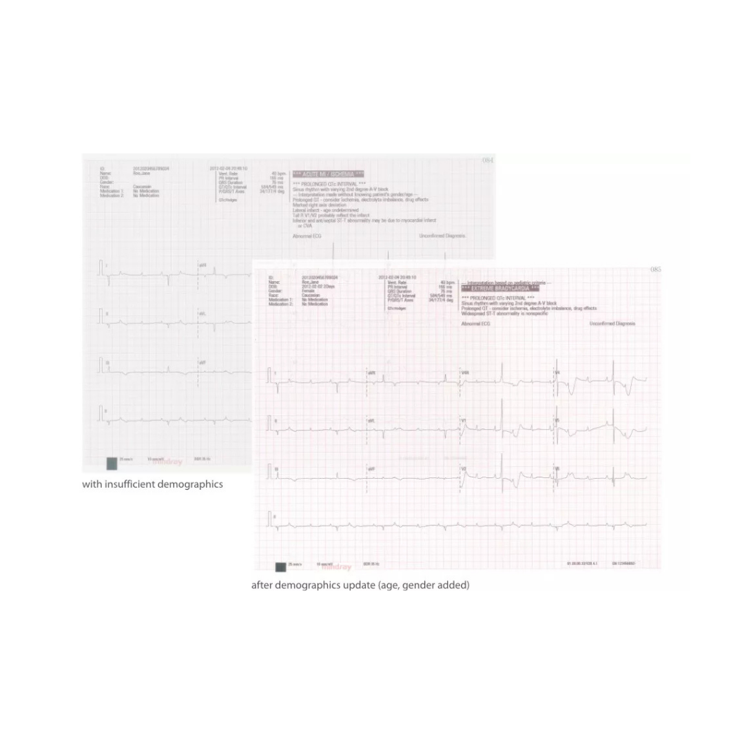 Papel de Impresión para Electrocardiografo R12, 210mmX295mm, 150 hojas Mindray